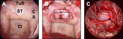 Closure strategy for endoscopic pituitary surgery: Experience from 3015 patients